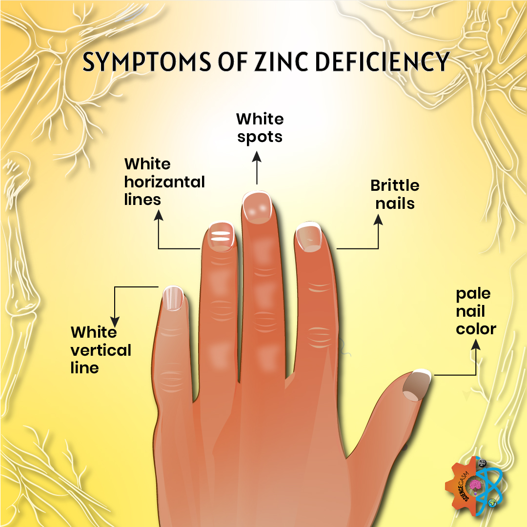 Symptoms of Zinc deficiency in Nails