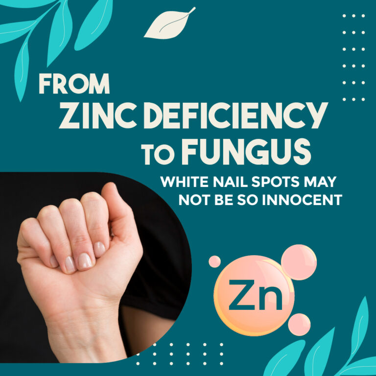 Close-up of fingernails showing white spots with text “From Zinc Deficiency to Fungus – White Nail Spots May Not Be So Innocent”