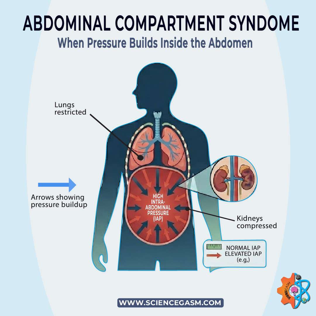 Abdominal compartment syndrome showing increased intra abdominal pressure affecting lungs kidneys and organs