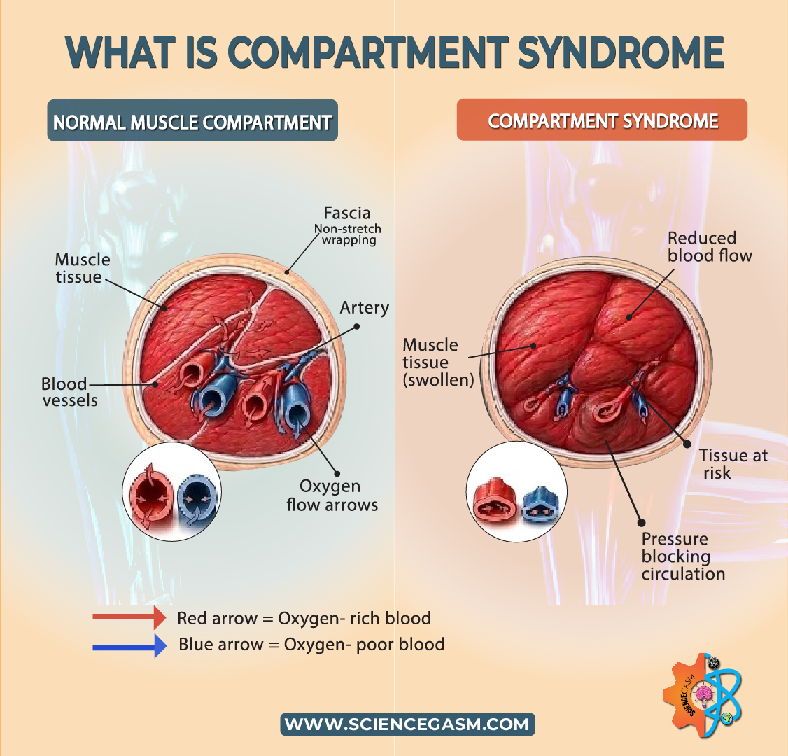 What is compartment syndrome diagram showing normal vs increased pressure in muscle compartments and reduced blood flow